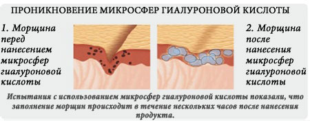 проникновение микросфер гиалуроновой кислоты